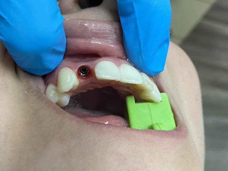Before Image: Dental Implant in the Anterior Esthetic Zone - front