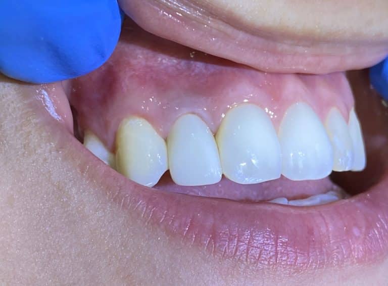 After Image: Dental Implant in the Anterior Esthetic Zone - front
