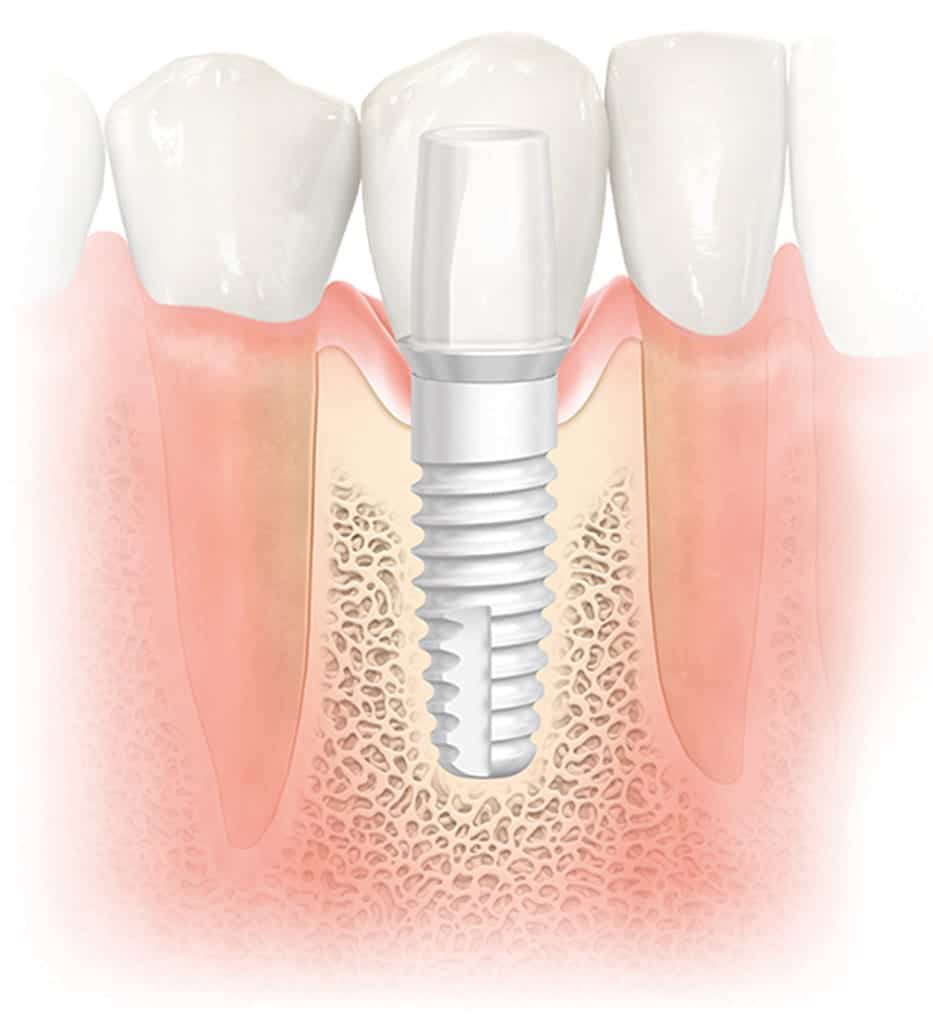 Nobel BiocarePearl 2