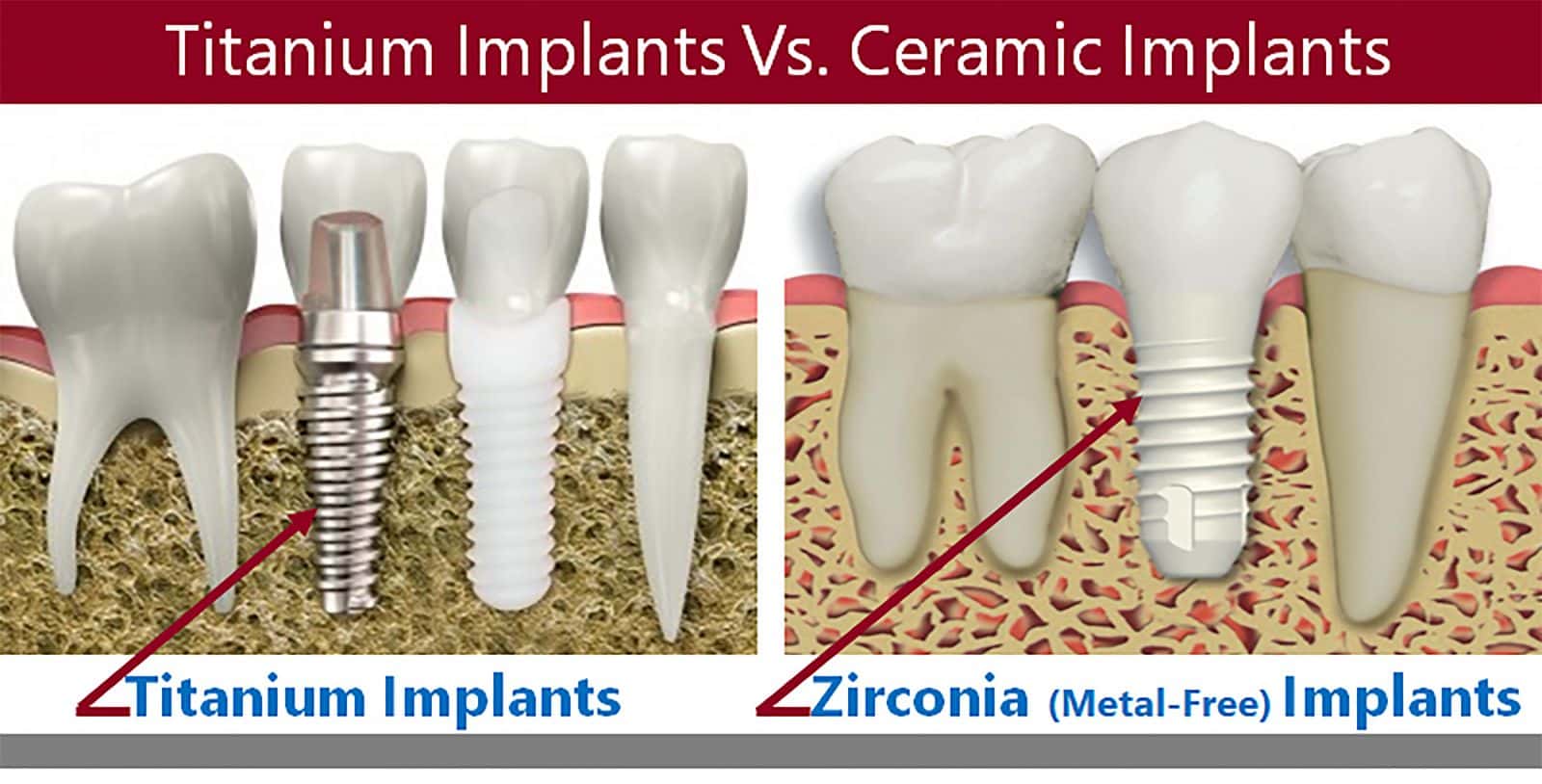 dental implants 55