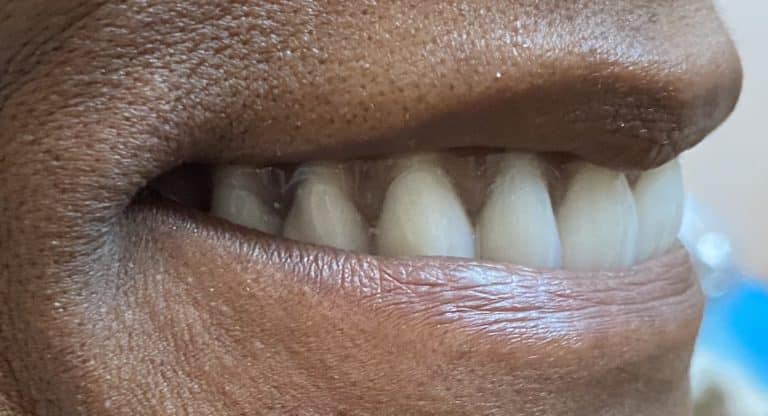 After Image: Multiple Implants in the Upper Maxillary Arch with Screw-Retained Prosthesis - right-front-oblique