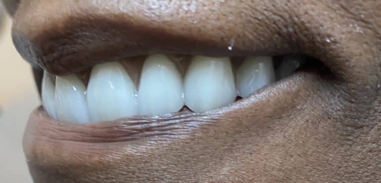 After Image: Multiple Implants in the Upper Maxillary Arch with Screw-Retained Prosthesis - left-front-oblique