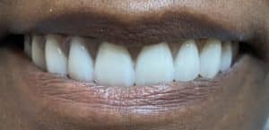 After Image: Multiple Implants in the Upper Maxillary Arch with Screw-Retained Prosthesis