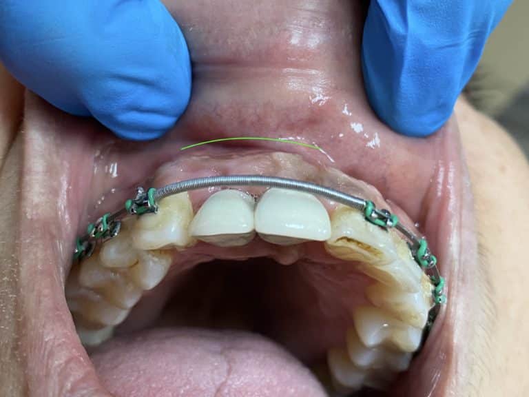 After Image: 2 Dental Implants in the Aesthetic Zone - front