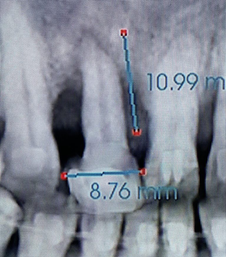Before Image: 2 Dental Implants in the Aesthetic Zone - front