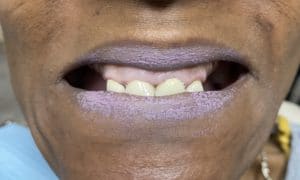 Before Image: Multiple Implants in the Upper Maxillary Arch with Screw-Retained Prosthesis
