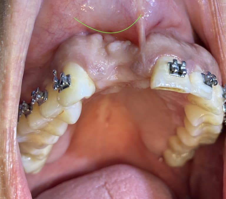 Before Image: 2 Dental Implants in the Aesthetic Zone - front