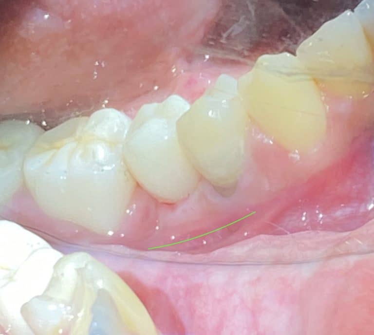 After Image: Dental Implant in the Posterior Region - front