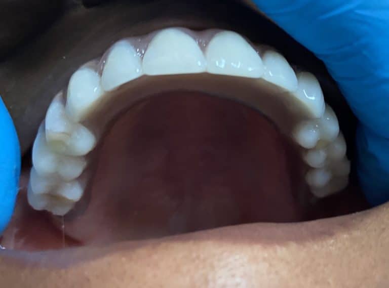 After Image: 6 Implants in the Maxillary Upper Arch with a Fixed or Screw-Retained Prosthesis (All-on-6) - front