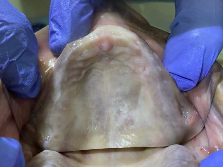 Before Image: 6 Implants in the Maxillary Upper Arch with a Fixed or Screw-Retained Prosthesis (All-on-6) - front