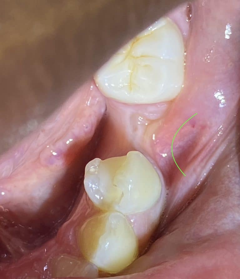 Before Image: Dental Implant in the Posterior Region - front