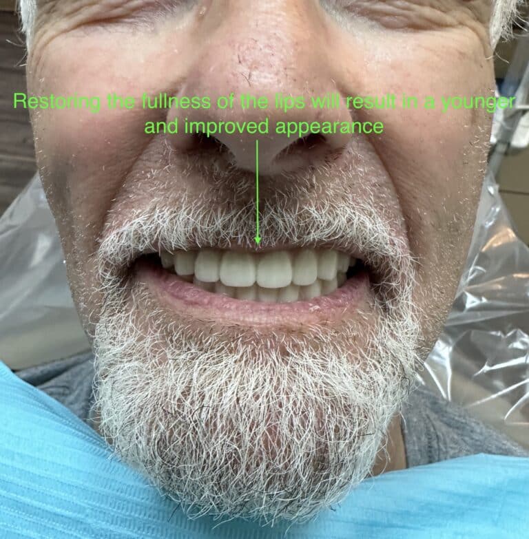 After Image: Upper and Lower Multiple Implants with Full-Arch Fixed (Screw-Retained) FP-3 Implant Prostheses - front