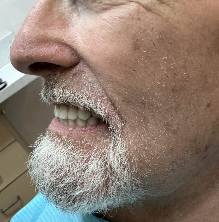 After Image: Upper and Lower Multiple Implants with Full-Arch Fixed (Screw-Retained) FP-3 Implant Prostheses - left-side
