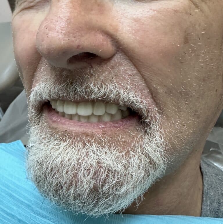 After Image: Upper and Lower Multiple Implants with Full-Arch Fixed (Screw-Retained) FP-3 Implant Prostheses - left-front-oblique
