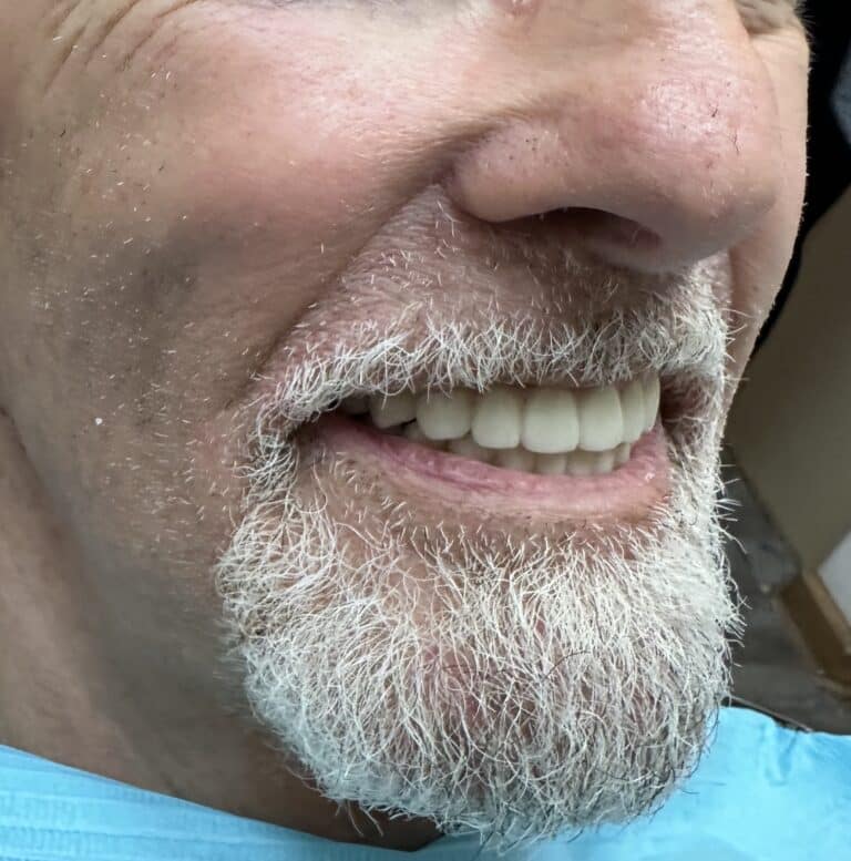 After Image: Upper and Lower Multiple Implants with Full-Arch Fixed (Screw-Retained) FP-3 Implant Prostheses - right-front-oblique