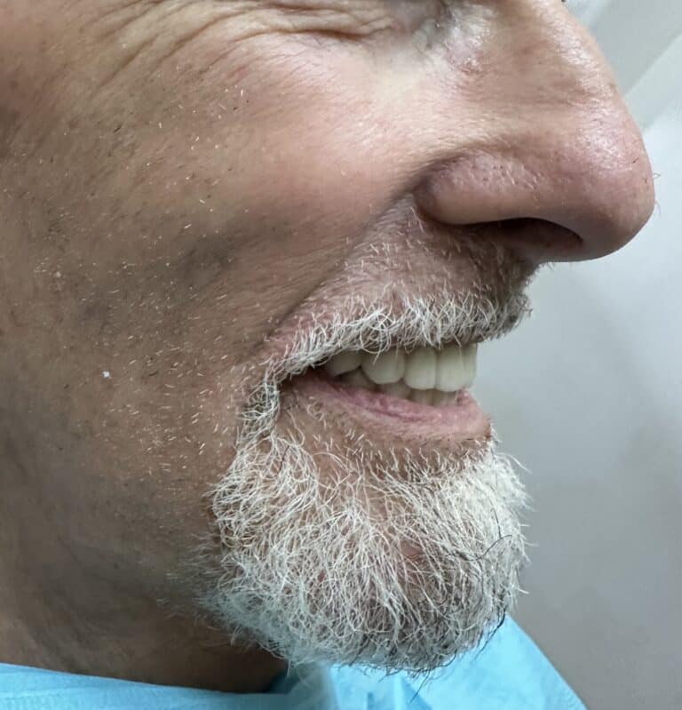 After Image: Upper and Lower Multiple Implants with Full-Arch Fixed (Screw-Retained) FP-3 Implant Prostheses - right-side