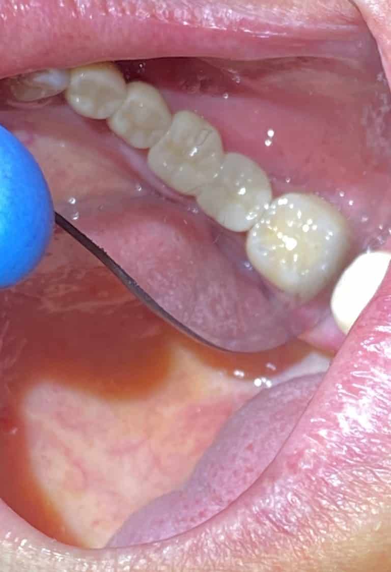 After Image: 4 Dental Implants in the Posterior Region - front