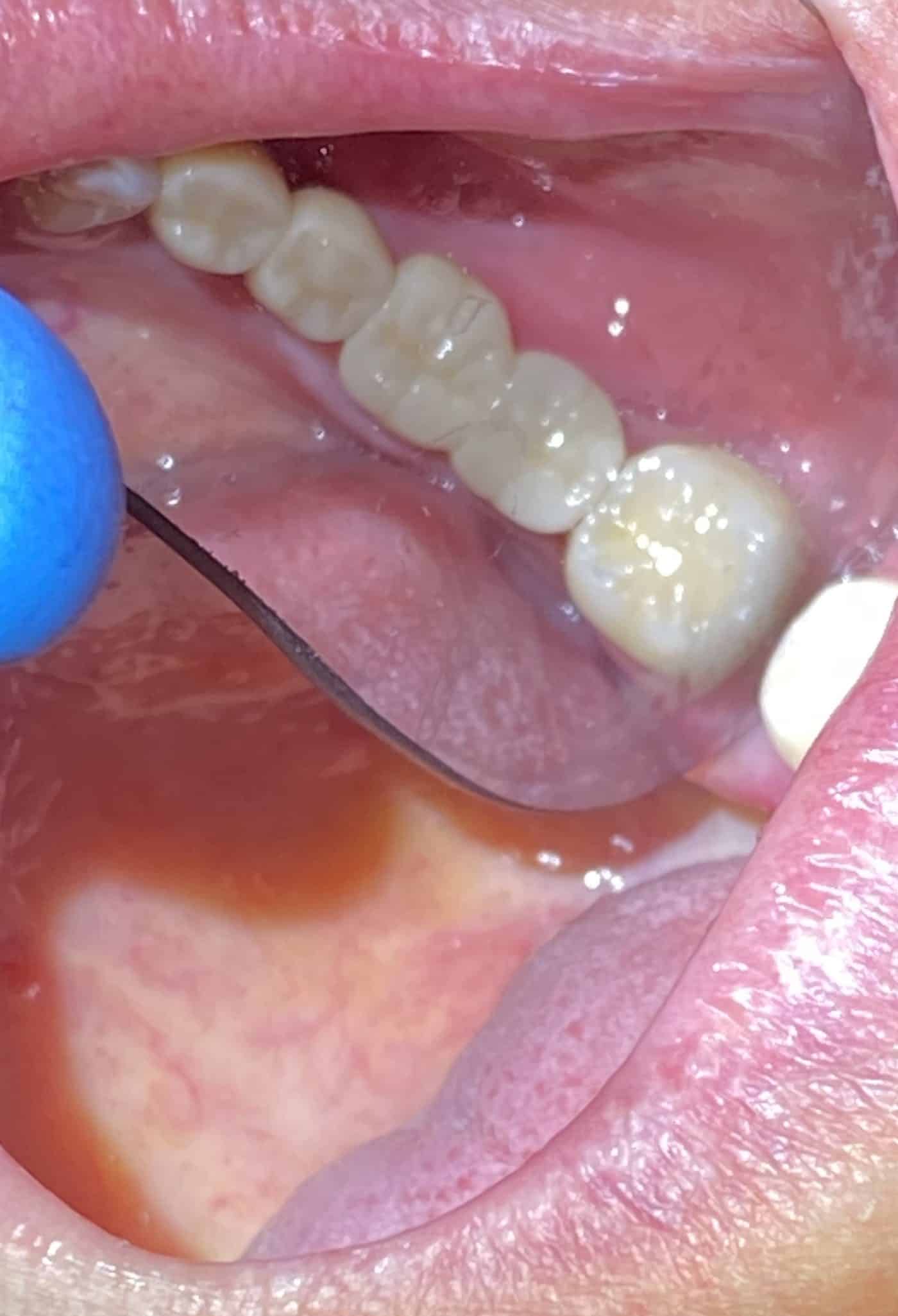 4 Dental Implants in the Posterior Region