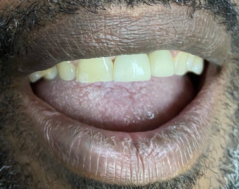 After Image: Dental Implants in the Anterior Esthetic Zone - front