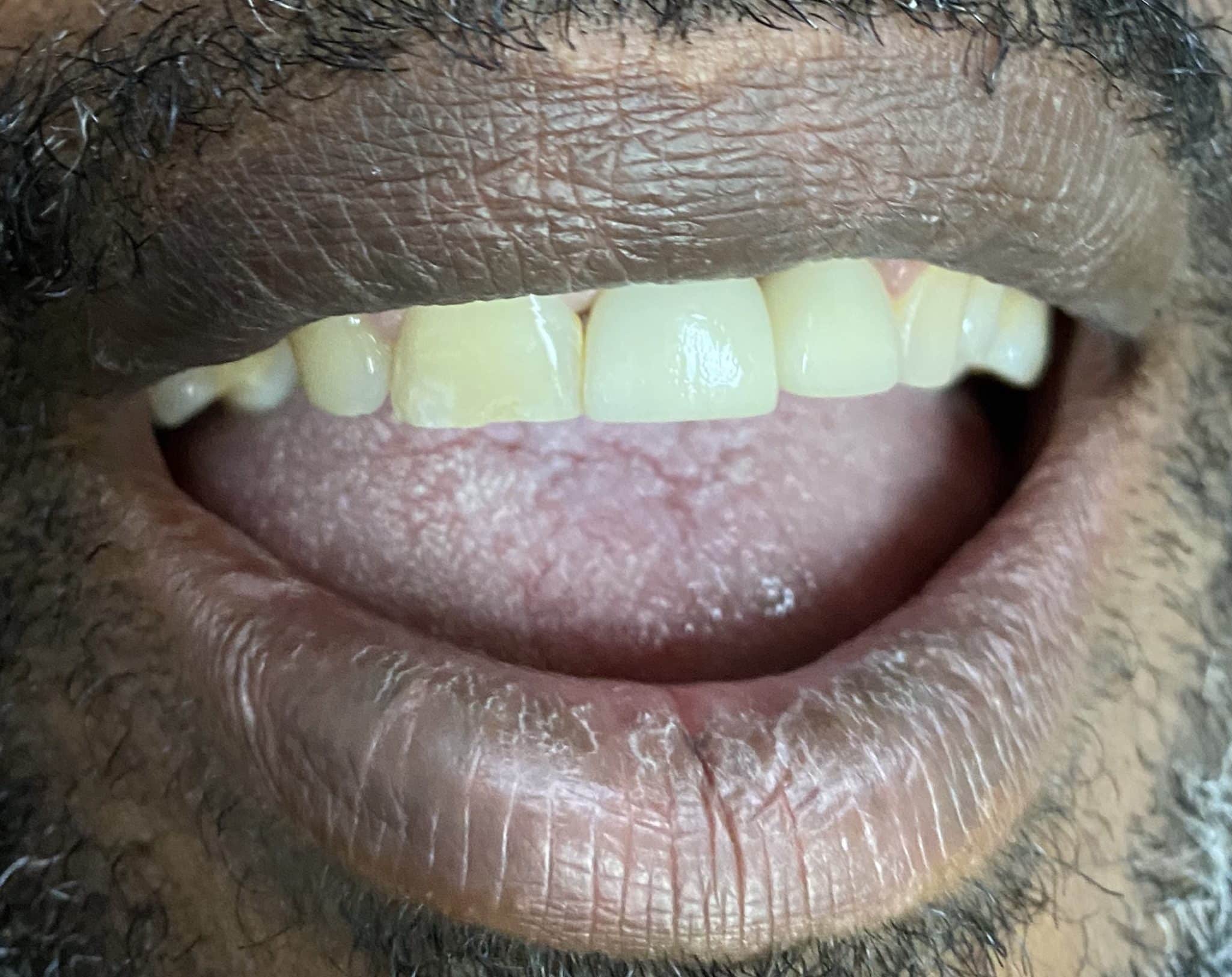 Dental Implants in the Anterior Esthetic Zone
