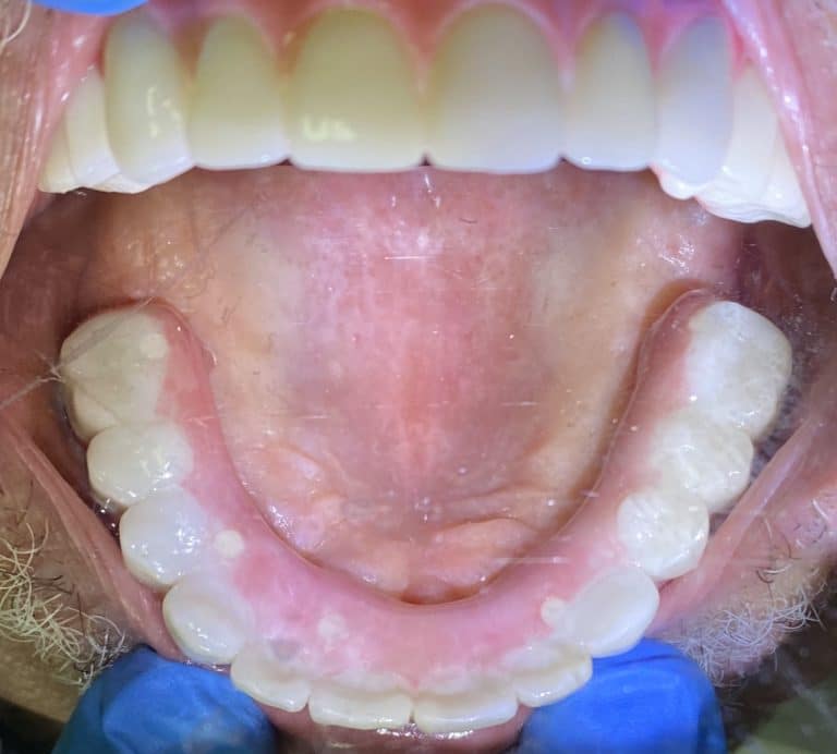 After Image: Upper and Lower Multiple Implants with Full-Arch Fixed (Screw-Retained) FP-3 Implant Prostheses - other