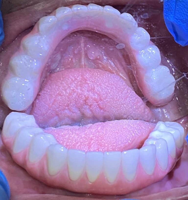 After Image: Upper and Lower Multiple Implants with Full-Arch Fixed (Screw-Retained) FP-3 Implant Prostheses - other