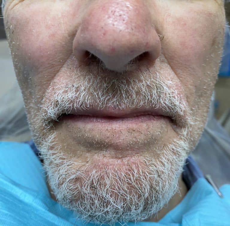 After Image: Upper and Lower Multiple Implants with Full-Arch Fixed (Screw-Retained) FP-3 Implant Prostheses - front