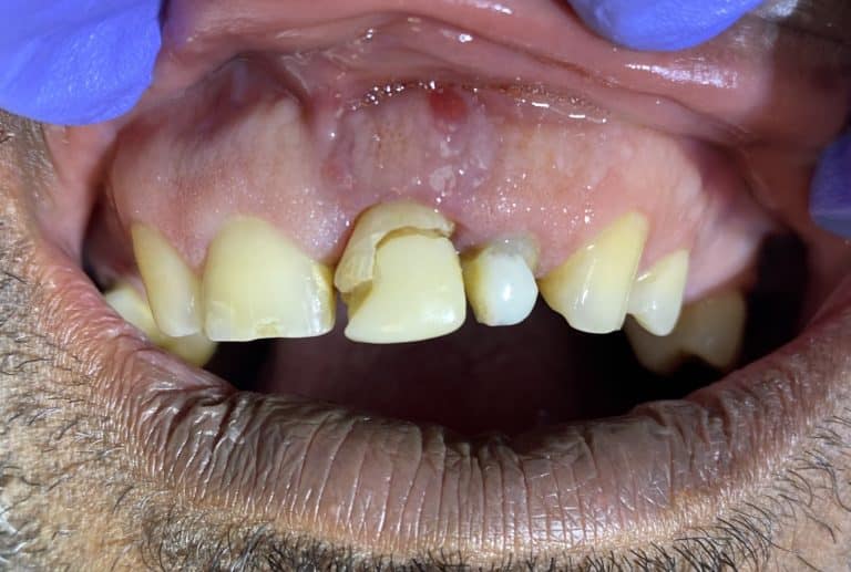 Before Image: Dental Implants in the Anterior Esthetic Zone - front