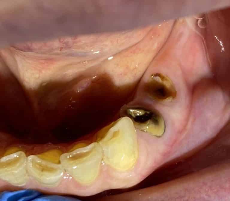 Before Image: 4 Dental Implants in the Posterior Region - front