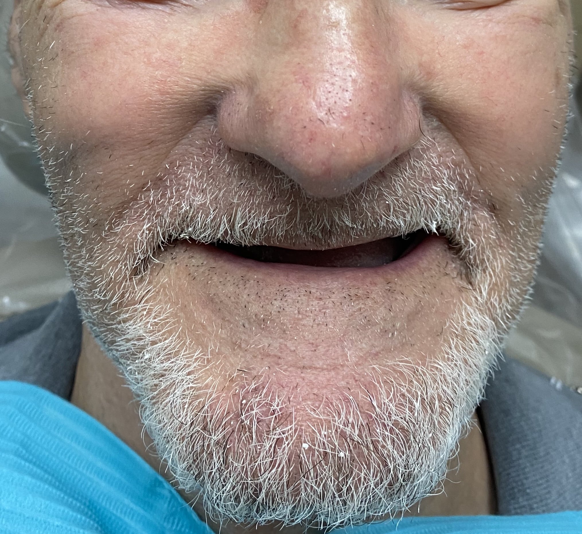 Before Image of Full-Arch Fixed Implant Prostheses Houston TX