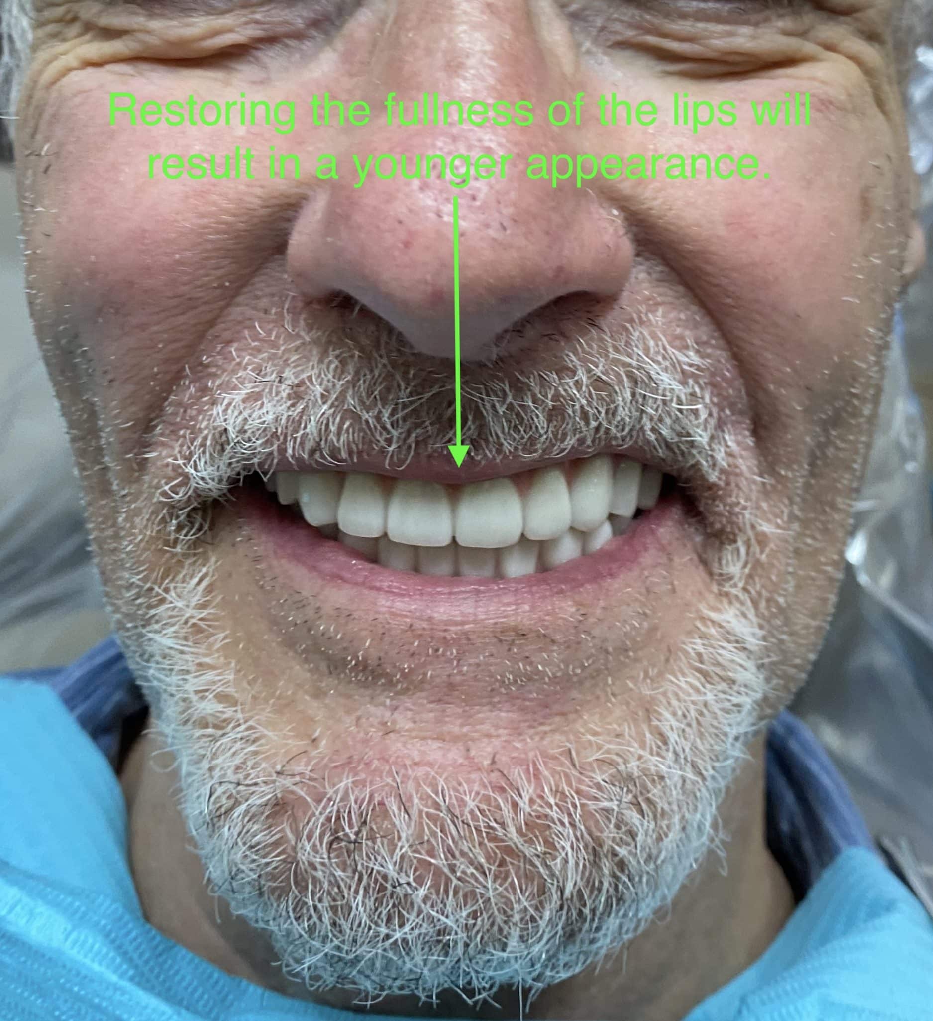 After Image of Full-Arch Fixed Implant Prostheses Houston TX