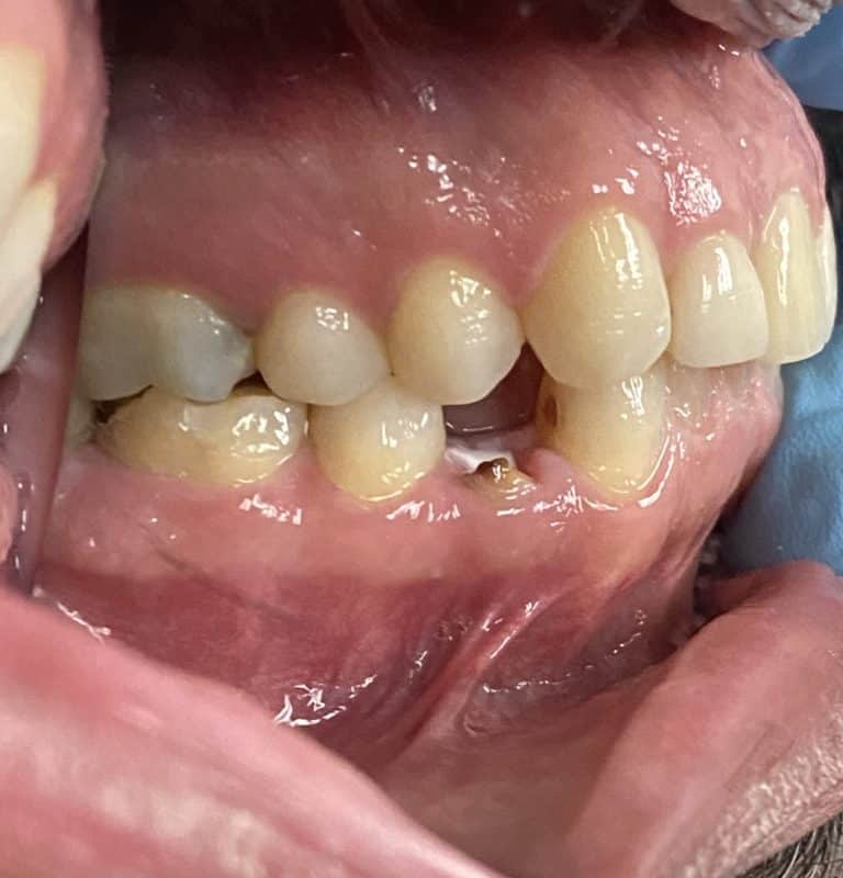 Before Image: Single Implant Placement in the Posterior Region following a Tooth Extraction - left-side