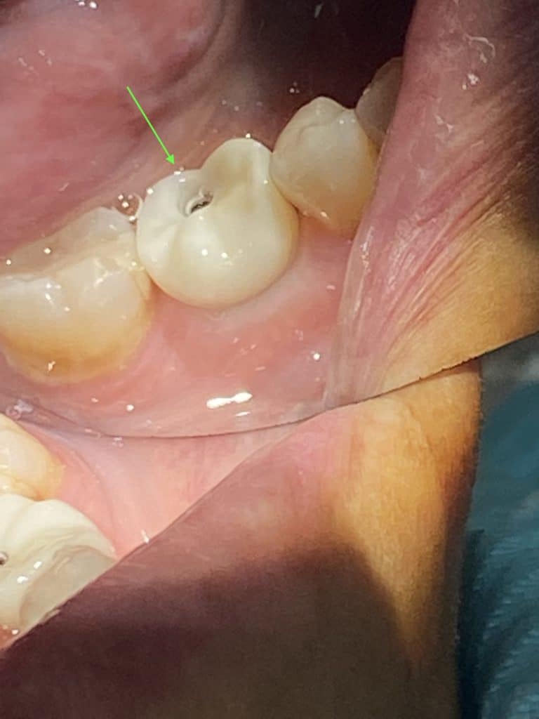 After Image: Single Implant with Implant Crown in the Posterior Region - left-side