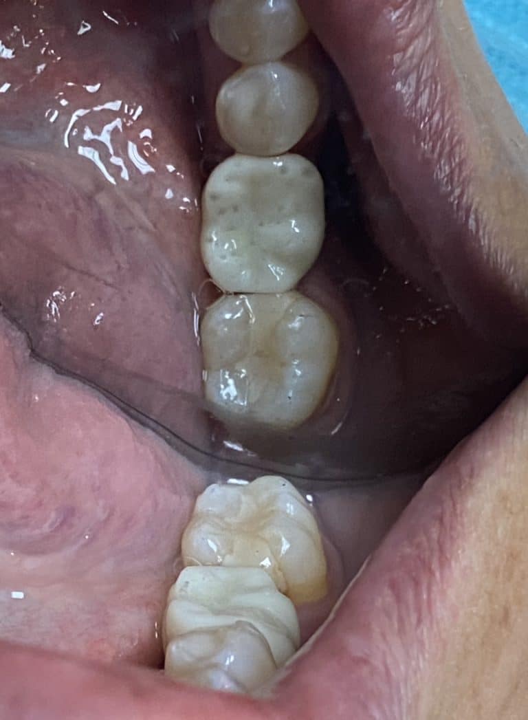 After Image: Single Implant with Implant Crown in the Posterior Region - other