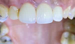 Single Implant in the Anterior Esthetic Zone