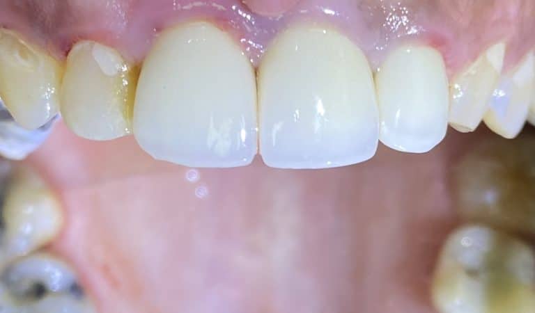 After Image: Single Implant in the Anterior Esthetic Zone - front
