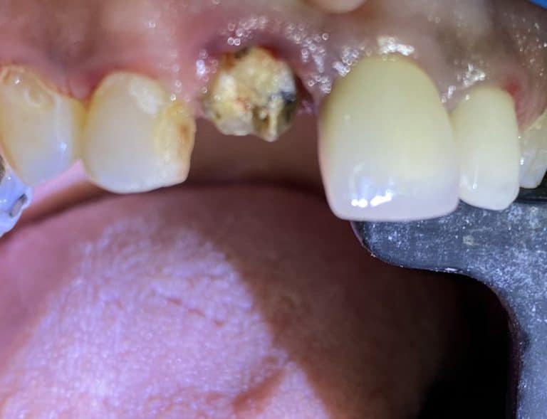 Before Image: Single Implant in the Anterior Esthetic Zone - front