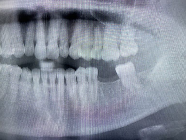 Before Image: Single Implant with Implant Crown in the Posterior Region - left-side