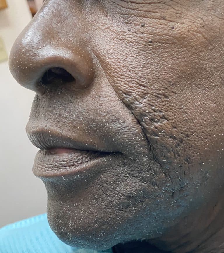 After Image: Upper Full-Arch with Multiple Implants and Implant Bridge - left-front-oblique