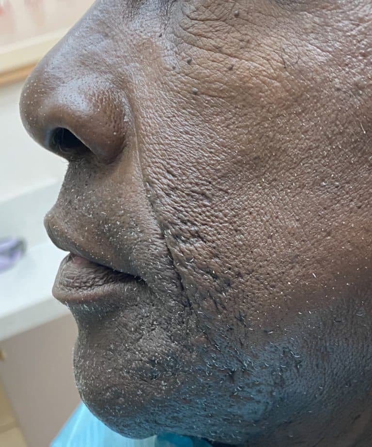 After Image: Upper Full-Arch with Multiple Implants and Implant Bridge - left-side
