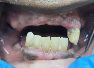 Before Image: Upper Full-Arch with Multiple Implants and Implant Bridge