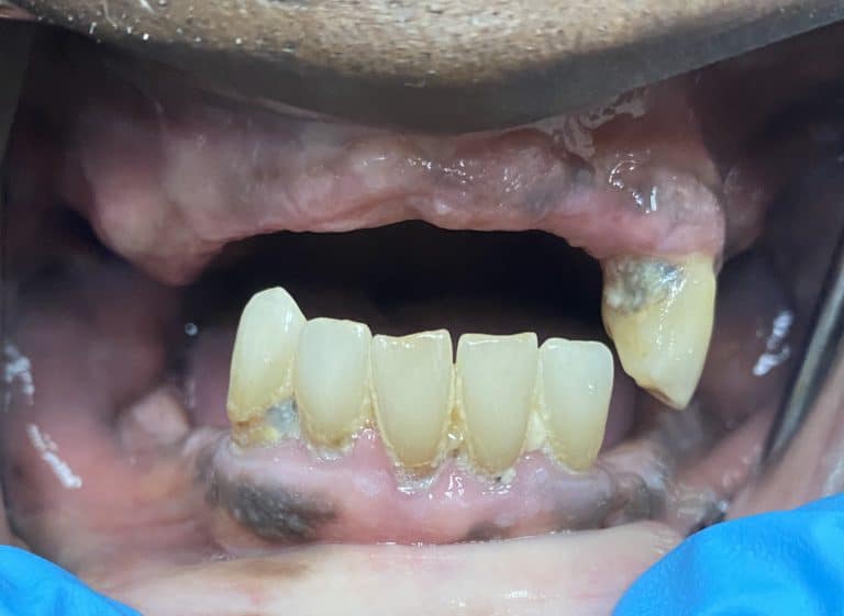 Before Image: Upper Full-Arch with Multiple Implants and Implant Bridge - front