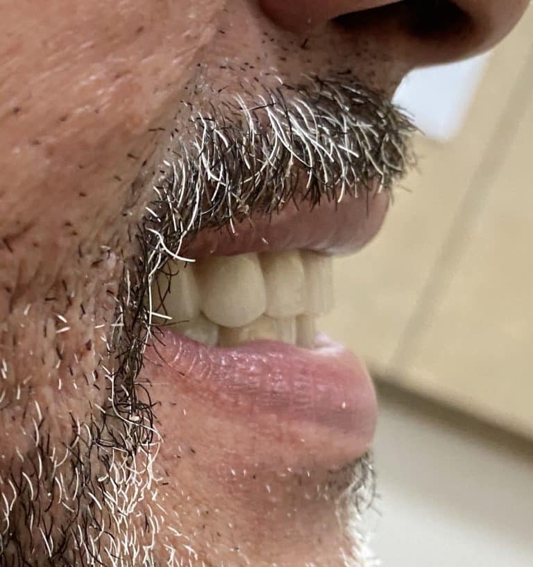 After Image: Upper Full-Arch Implants with Oral Prosthesis - right-side