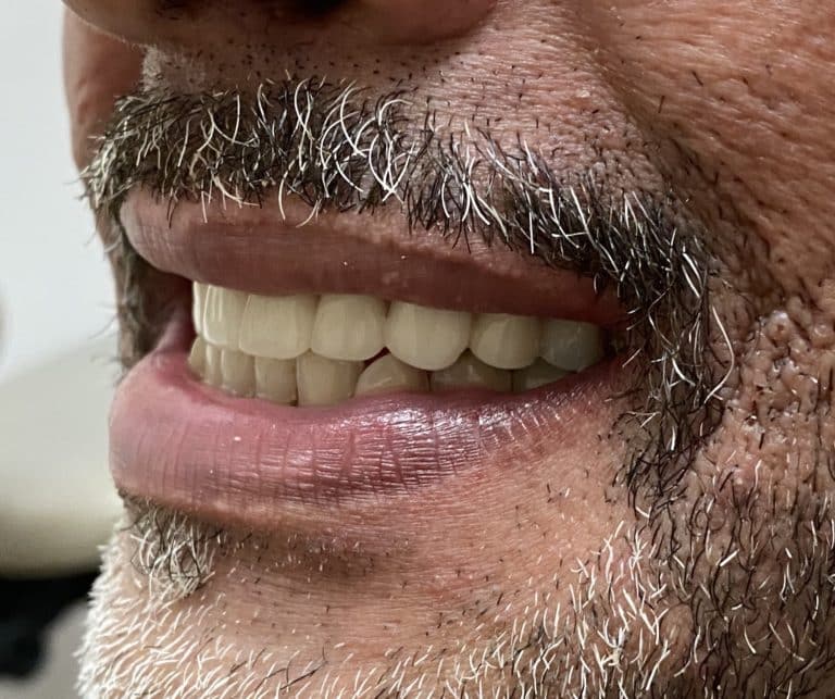 After Image: Upper Full-Arch Implants with Oral Prosthesis - left-front-oblique