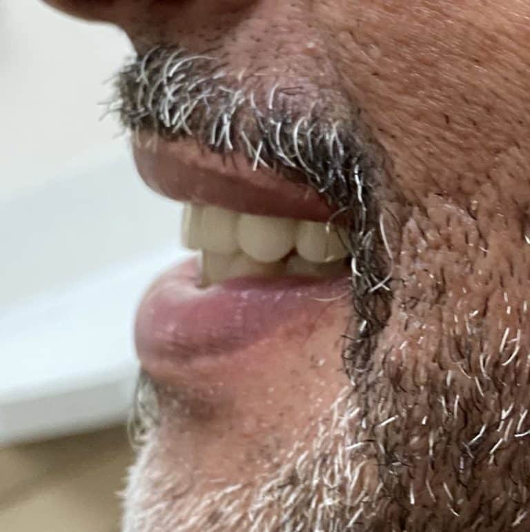 After Image: Upper Full-Arch Implants with Oral Prosthesis - left-side