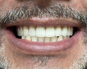 After Image: Upper Full-Arch Implants with Oral Prosthesis