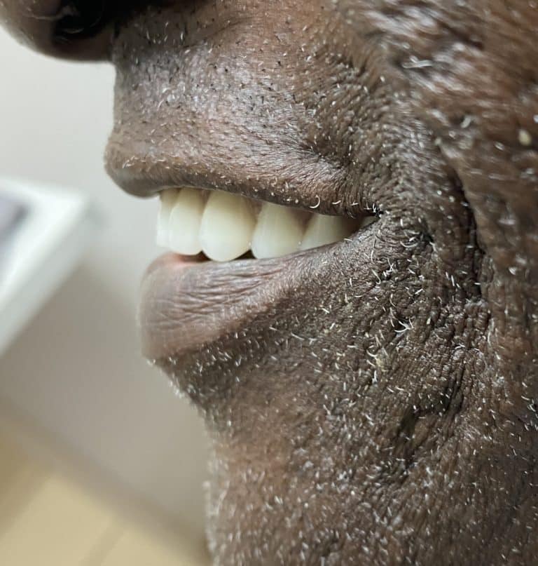 After Image: Upper Full-Arch with Multiple Implants and Implant Bridge - left-side