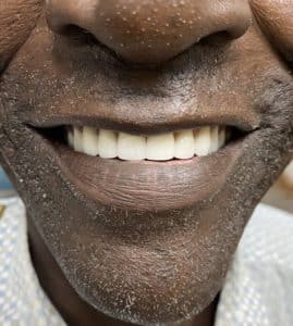 After Image: Upper Full-Arch with Multiple Implants and Implant Bridge