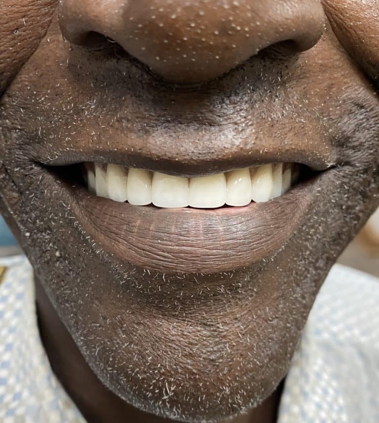 After Image: Upper Full-Arch with Multiple Implants and Implant Bridge - front