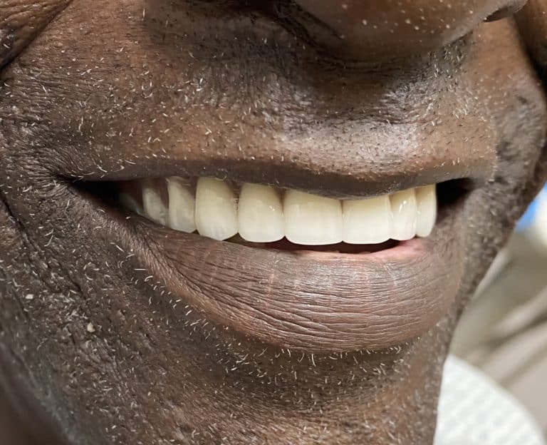 After Image: Upper Full-Arch with Multiple Implants and Implant Bridge - right-front-oblique